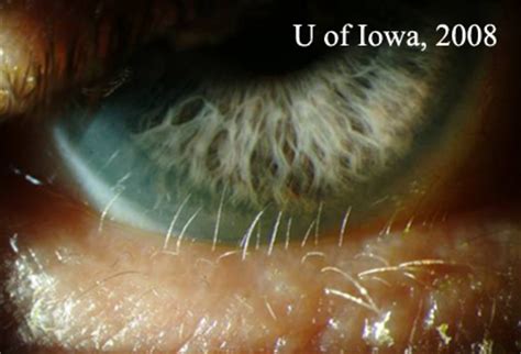 cas Distichiasis cils supplémentaires EyeRounds org Ophtalmologie Université de l