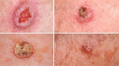 Рак кожи симптомы классификация и диагностика признаки и лечение