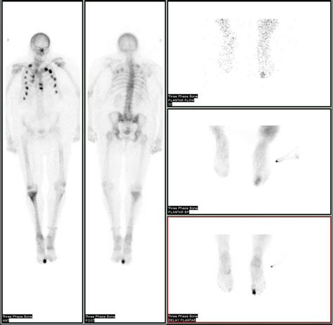 3 Phase Tc99m Mdp Bone Scan Ro Osteomyelitis Of R Great Toe Rradiology