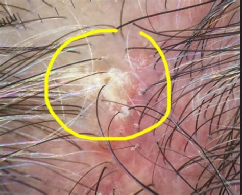 Actinic Keratosis Of The Scalp — Donovan Hair Clinic