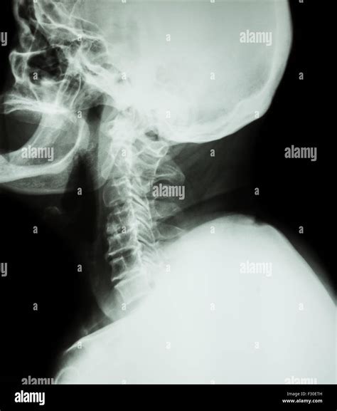 Cervical Spondylosis Film X Ray Of Cervical Spine Lateral Position