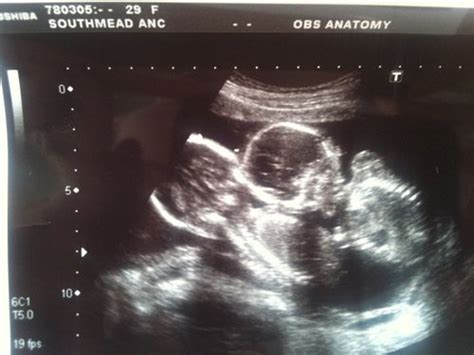 15 недель беременности фото узи двойня