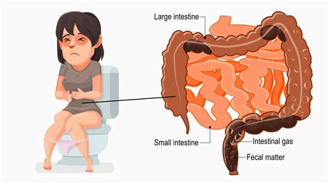 Intestine Popping Out Rectal Prolapse Symptoms Causes Treatment Surgery