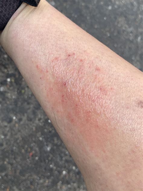 What Is This Rash On My Calf More In Comments Rdermatology
