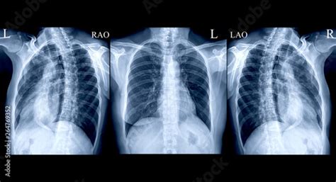 Collection Chest X Ray Or X Ray Image Of Human Ap And Both Oblique View
