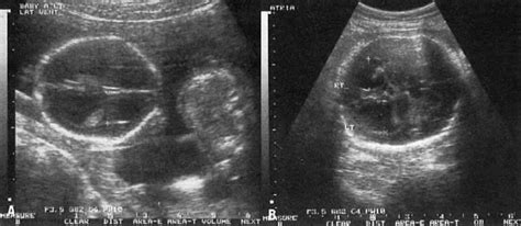 Fetal Anomalies Ultrasound