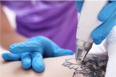 Tattoo Removal Western Maryland Dermatology