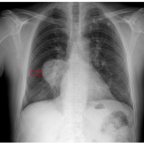 Hydatid Cyst Has A Non Specific Appearance On Chest Radiography