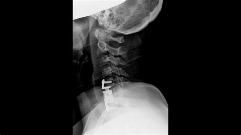 Fracture C6 Anterior Micro Surgical Decompression Of Spinal Cord