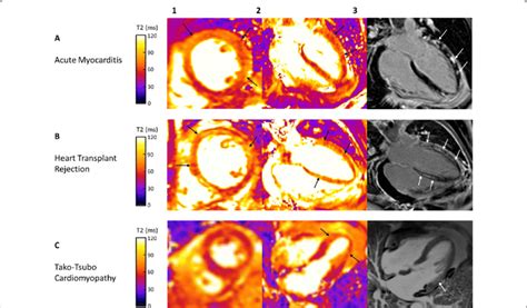 Cardiovascular Magnetic Resonance Imaging In Patients With Presence Of