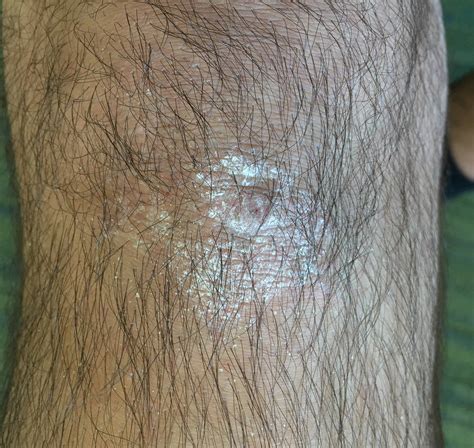 White Patch Of Skin On Knee Lasopaexperience