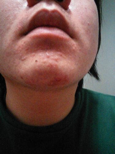 Bumps In Chin General Redness Please Help Scar Treatments Acne