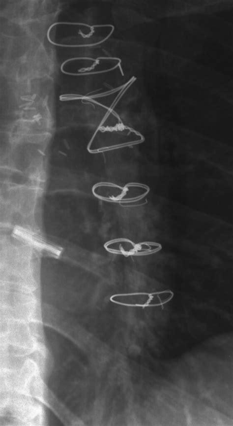 Can You Break A Sternum Wire Two Years Postop Valvereplacement