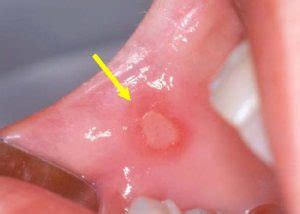 Most blisters are filled with a clear fluid, either serum or plasma. How to get rid of blood blister inside cheek: treatments ...