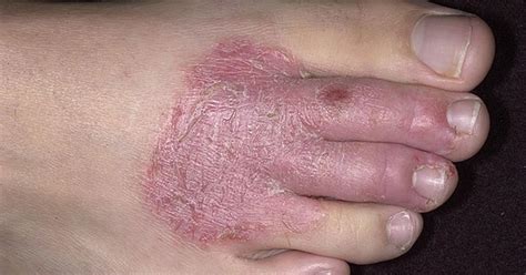What Does Stress Eczema Look Like