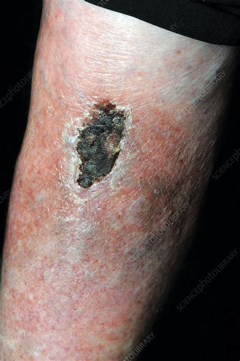 Scab On Leg Wound Stock Image C0197563 Science Photo Library