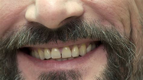 Smile of a bearded man. Smiling mouth close up. Tips for healthy teeth ...