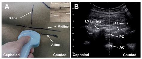 Jcm Free Full Text Dual Vs Single Plane Ultrasonic Scan Assisted