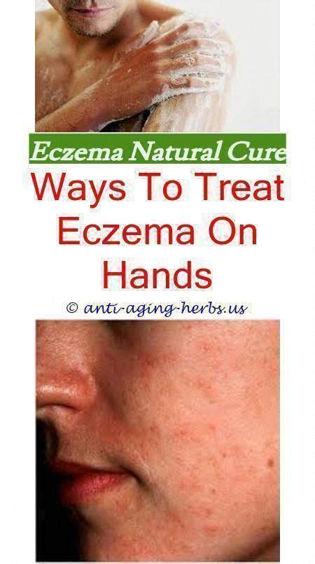 44 Dyshidrotic Eczema Warts On Hands Pictures