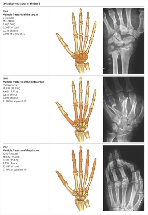 Hand Fractures Musculoskeletal Key