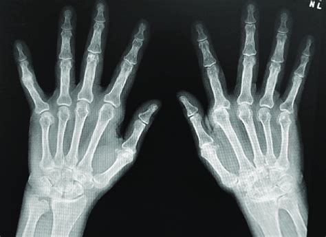 Hand Radiograph Of Patient With Rheumatoid Arthritis Download