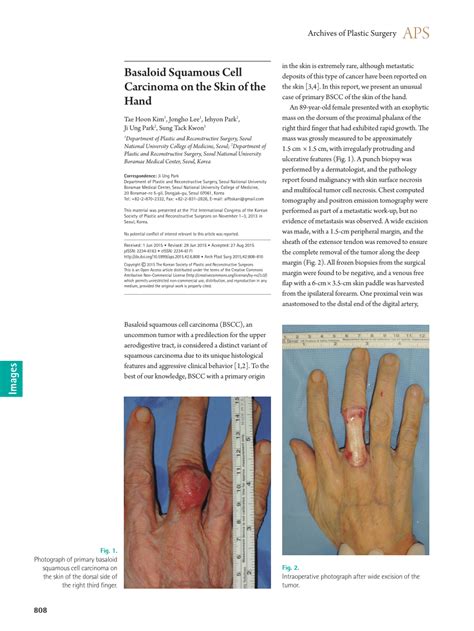 Pdf Basaloid Squamous Cell Carcinoma On The Skin Of The Hand