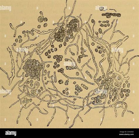 Tinea Versicolor Microscopic