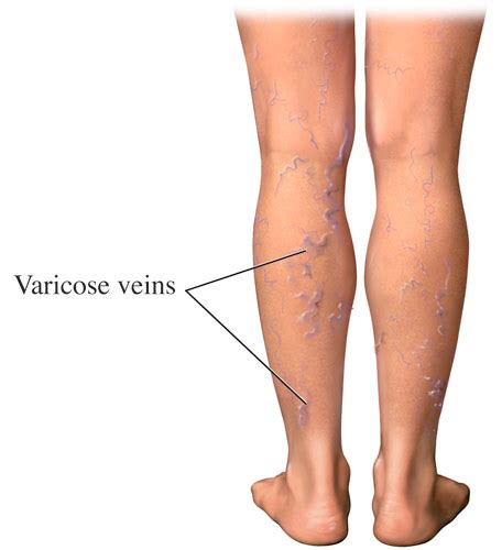 Varicose Veins Treatment In New Jersey Vascular Care