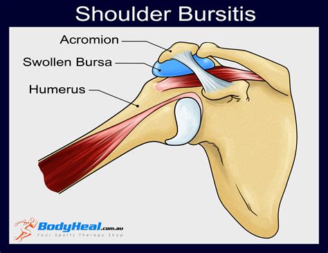 Slideshow Visual Guide To Bursitis Bursitis Tendinitis Sore Shoulder My Xxx Hot Girl