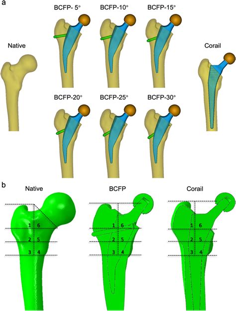 A Native Model And Implanted Models With Bcfp And Corail B Region