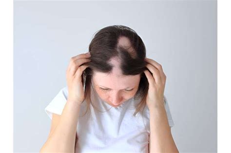 A New Treatment Option For A Form Of Sudden Hair Loss