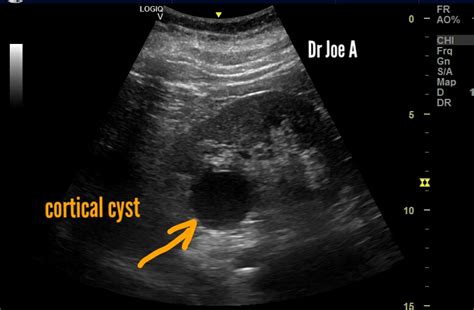 Ultrasound Imaging Simple Renal Cyst