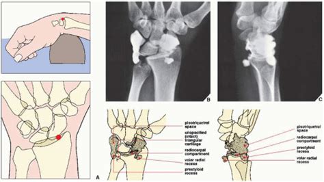 Upper Limb Iii Distal Forearm Wrist And Hand Radiology Key