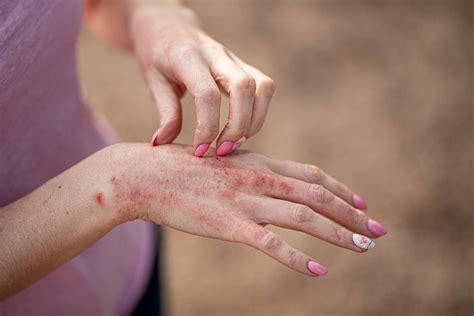 Contact Dermatitis Types Symptoms Causes Diagnosis Treatment And More