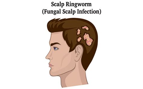 Fungal Scalp Infection Or Tinea Capitis How To Identify And Treat It