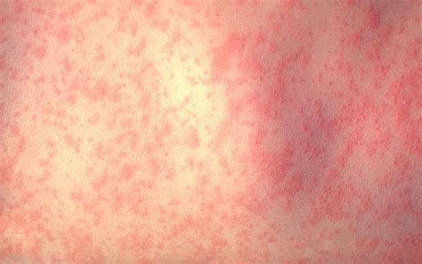 What You Need To Know About Measles Cedars Sinai
