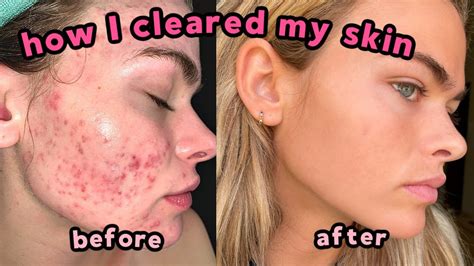 My Accutane Experience How I Cleared My Severe Acne Q A With Lots Of Pictures YouTube
