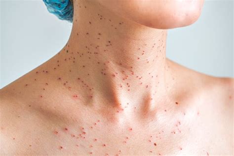Blood Spots On Skin Pictures
