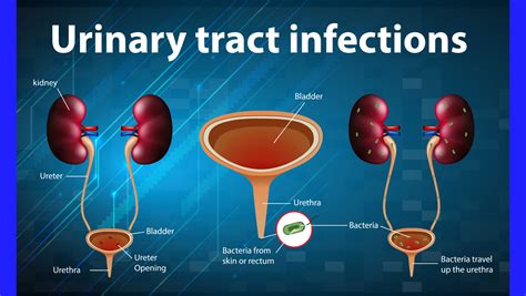 Homeopathy For Treating Urinary Tract Infections Get Rid Of Uti