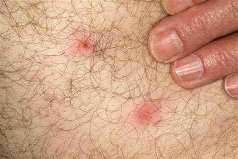 Types Of Tick Bites