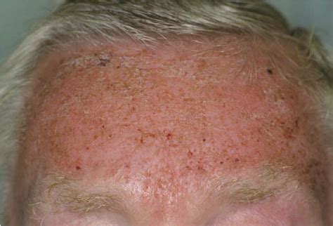 Acute Irritant Contact Dermatitis On The Forehead 1 Week After The