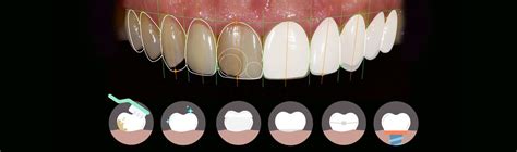 Check spelling or type a new query. How long does cosmetic dentistry last? - Revitalise Dental ...