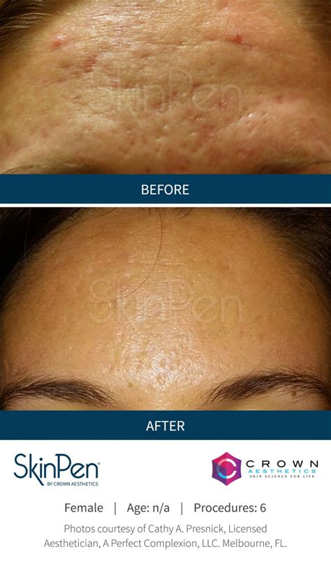 Skinpen Before And After Skinpen Microneedling Crown Aesthetics