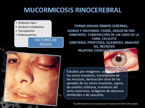 Mucormicosis