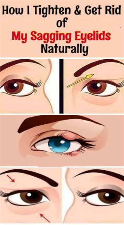 How I Get Rid Of My Sagging Eyelids Saggy Eyelids Skin Tightening