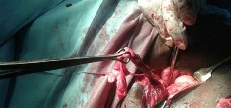 Case Report Perforated Appendix Within A Right Inguinal Hernia Sac