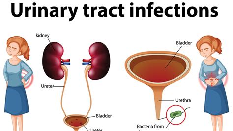 Understanding Urinary Tract Infections Symptoms Treatment And Prevention