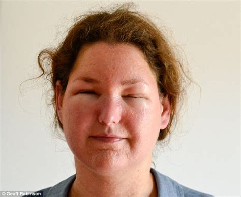 Mother Joanna Stockton Reveals She Feared Shed Go Blind After Allergic Reaction To Sun Cream