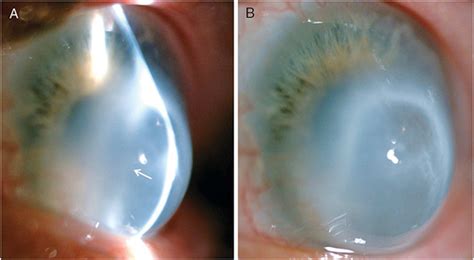 Persisting Extreme Acute Corneal Hydrops With A Giant Intrastromal