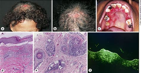 Figure 1 From Brunsting Perry Type Pemphigoid Causing Secondary